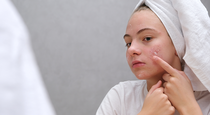 Anti Acne Facial