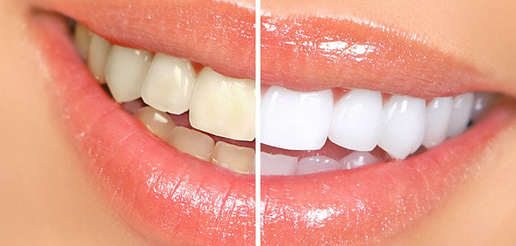 7 Natural Ways to Whiten Your Teeth Without the Dentist