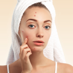 7 easy tips to avoid pimples