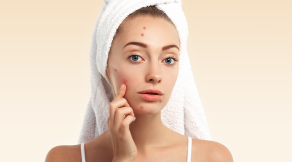 7 easy tips to avoid pimples