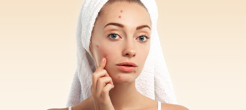7 easy tips to avoid pimples