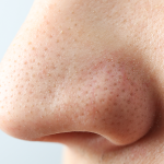 Tips to remove blackheads at home