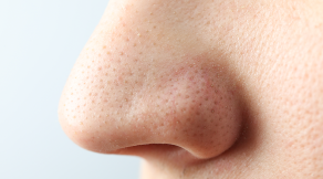 Tips to remove blackheads at home