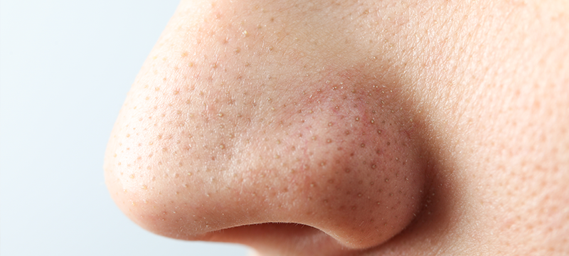 Tips to remove blackheads at home