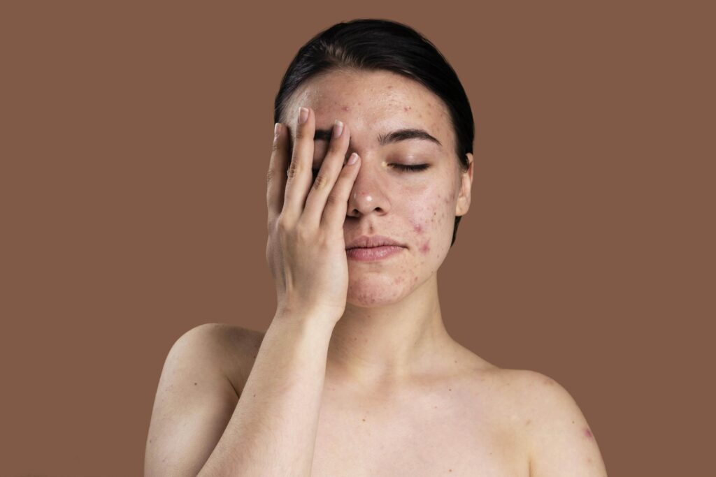 aloe vera for acne prone skin