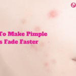 How To Make Pimple Marks Fade Faster