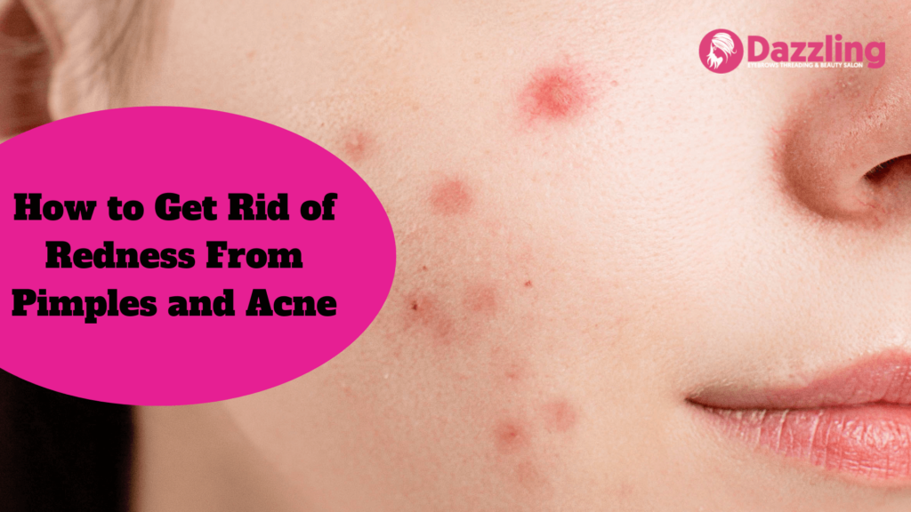 How to Get Rid of Redness From Pimples and Acne