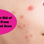 How to Get Rid of Redness From Pimples and Acne