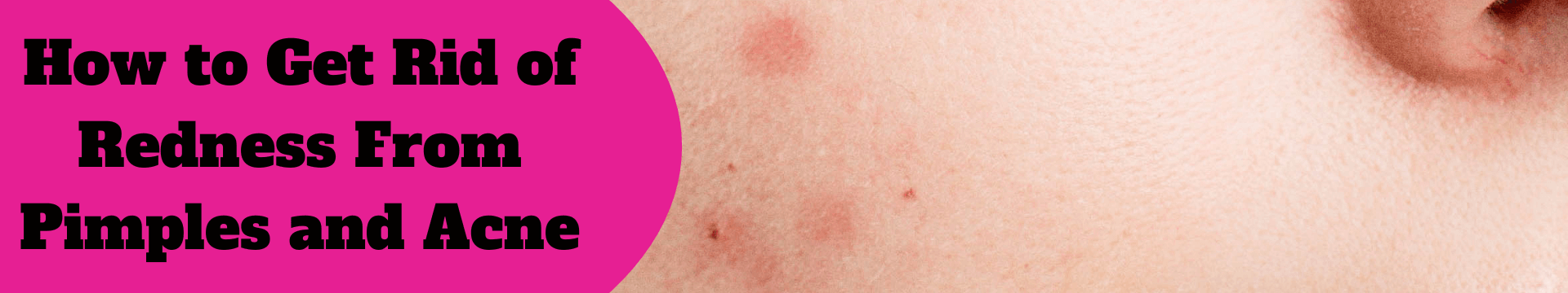 How to Get Rid of Redness From Pimples and Acne