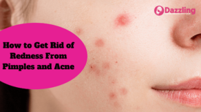 How to Get Rid of Redness From Pimples and Acne