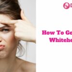 How To Get Rid of Whiteheads?