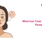 What Can Treat Large Facial Pores?