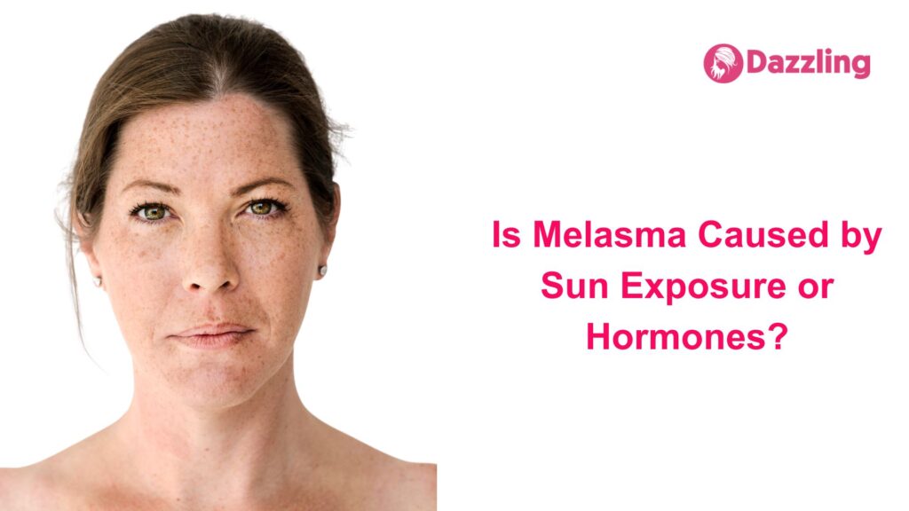 Is Melasma Caused by Sun Exposure or Hormones?