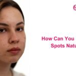 How Can You Fade Dark Spots Naturally?