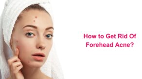 How to Get Rid Of Forehead Acne?
