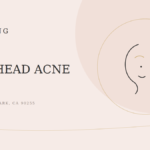 How to Get Rid of a Forehead Pimple Fast in 2026